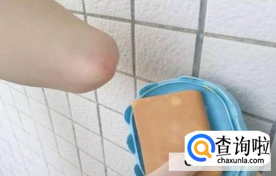 被蚊子咬了怎么处理