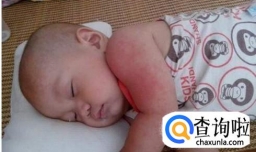 宝宝长痱子怎么治