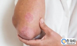 湿疹会不会传染给别人
