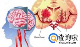 酮症酸中毒有哪些并发症