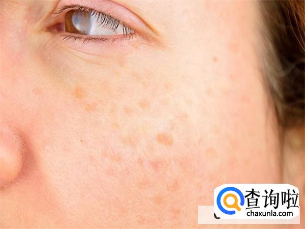 脸颊长斑怎样淡化