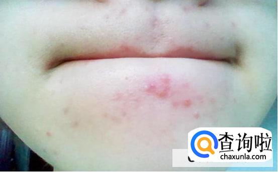 下巴长痘痘是什么火