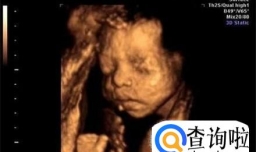 四维彩超看性别吗