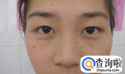 产后去除黄褐斑的方法有哪些？