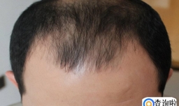 男性脱发厉害怎么办