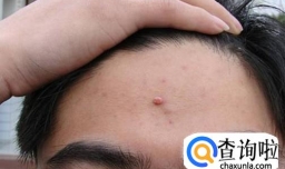 脸上不同部位长痘痘的原因是什么？