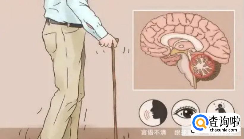 共济失调的类型有哪几种