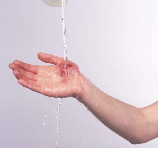 被猫咬了怎么办