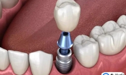 种植牙一颗要多少钱