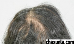 脱发严重生姜能治脱发吗