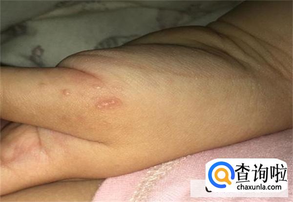 婴儿出水痘的症状