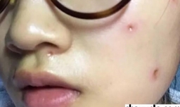 点痣要注意什么吗