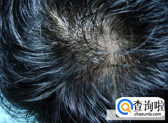 一挠头就掉头发怎么回事？