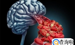 脑血管堵塞有“前兆” 这4个“红色信号” 希望家人早些发现