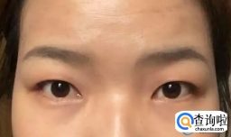 眼睛肿眼泡是如何造成的