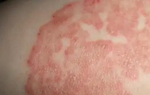 怎么做好皮炎的预防