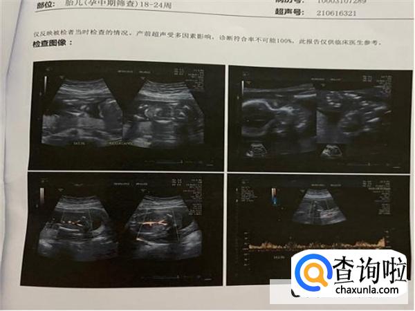 怀孕22周胖了8斤正常吗