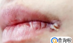 嘴唇起泡挑破好得快吗