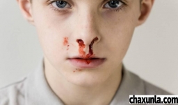 晚上流鼻血了怎么办