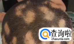 斑秃有哪些危害