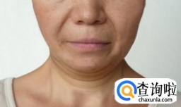 脸部下垂怎么恢复紧实？