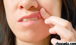 口腔溃疡怎么能好的快