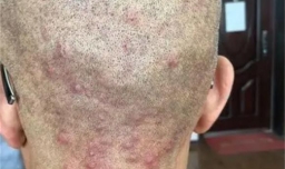 毛囊炎用什么药最有效