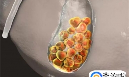 手术切除“胆囊”，会有哪些后遗症？医生讲出大实话，看完明白了