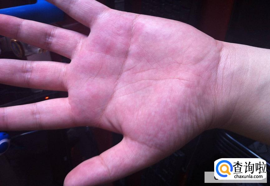 手经常蜕皮的原因