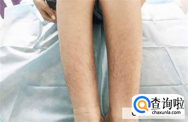 女性体毛过多的的原因是什么？