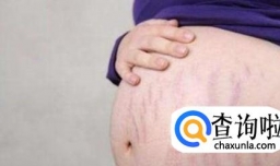 生完孩子妊娠纹会消失吗