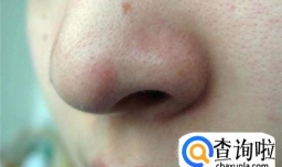 教你如何安全挤出黑头，不伤皮肤