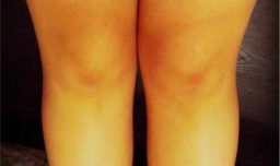 膝盖黑怎麽办？3步让膝盖美白，找回白皙美腿！