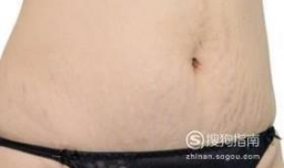 疤痕的类型有哪些？