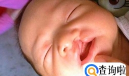 如何预防宝宝出现兔唇？