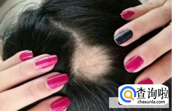 引起女性斑秃的原因