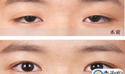 上眼睑下垂手术前后眼睛的图片对比