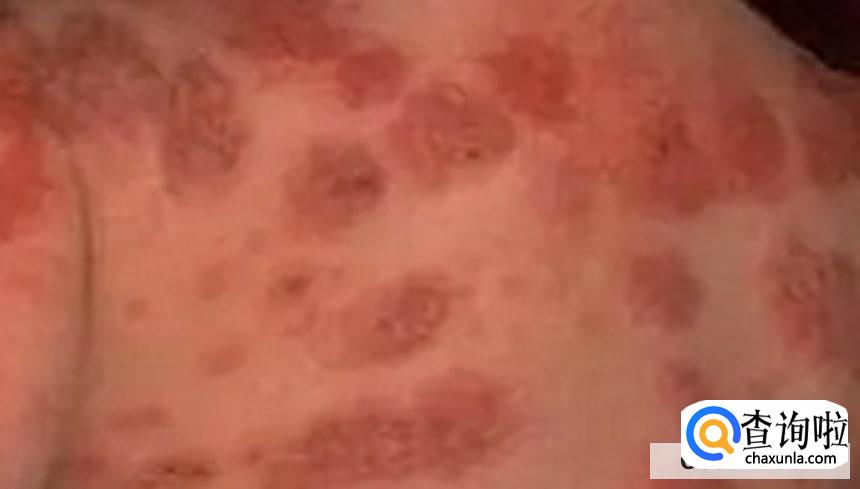 怎么做好皮炎的预防