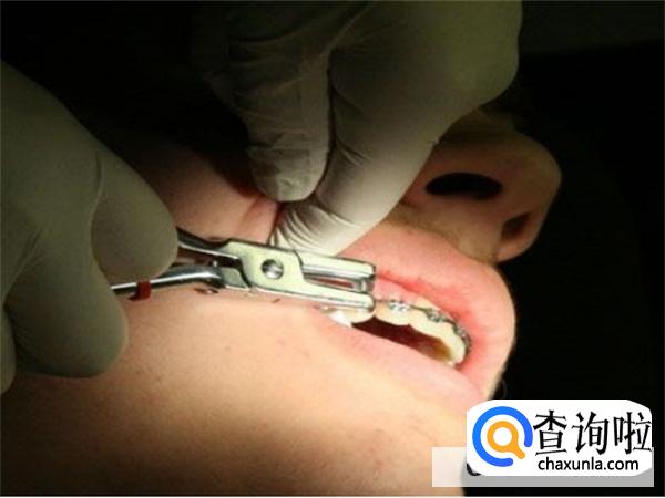 拨牙后几天恢复正常