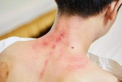 刮痧多久可以洗澡