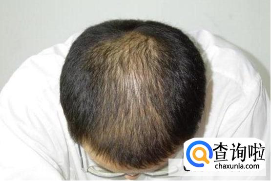 引起脱发的原因