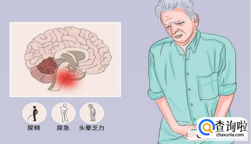 共济失调的类型有哪几种