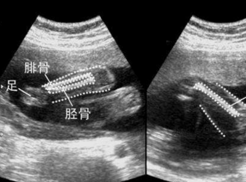 股骨长是什么意思