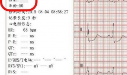 解读体检报告之心电图