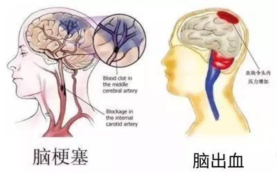 脑梗的症状都有哪些前期症状
