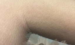 鱼鳞病的原因及护理