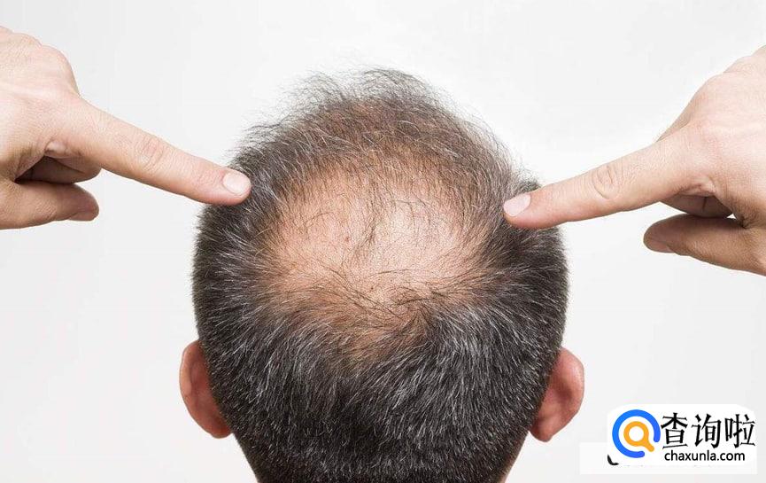 男性脱发厉害怎么办
