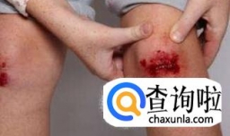 破伤风针打哪里