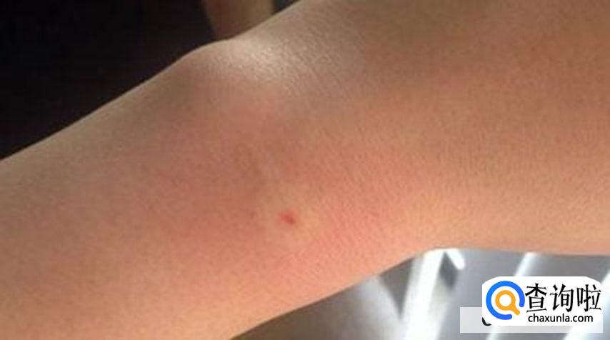 被蜂子蛰了怎么办