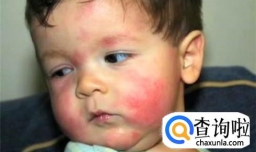 宝宝皮肤过敏有什么好的办法解决?